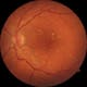 Photo Credit: Ophthalmic Practice Dr. Brusis, Germany
