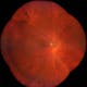 Dry age-related macular degeneration