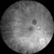 Image infrarouge d'un naevus choroïdien avec drusen sus-jacents