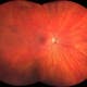 Ultra-Weitwinkel-Bild eines gesunden Auges