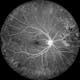 NEW Fluorescein Angiography
