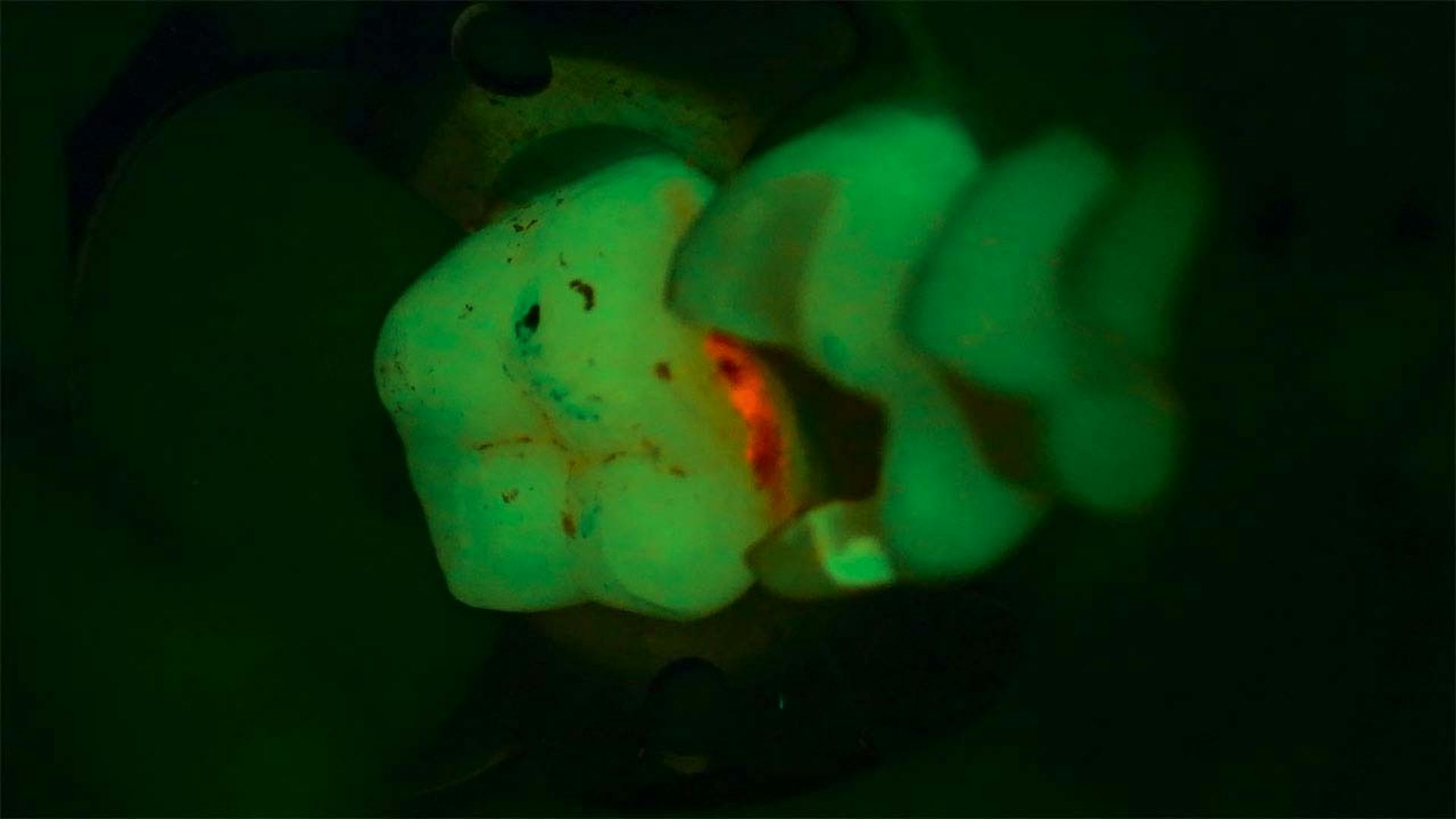 Détection des caries avec le mode Fluorescence du microscope dentaire ZEISS EXTARO 300