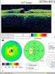 Optischer Kohärenztomograph (OCT): Neuartiges bildgebendes Verfahren mit dem berührungsfrei hochaufgelöste Schnittbilder des Auges erzeugt werden können.