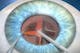 Removal of the cataract lens during surgery.
