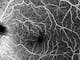 ZEISS CIRRUS 6000 8x8 mm HD AngioPlex OCT Angiography of proliferative diabetic retinopathy, PDR