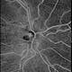 Angio 6x6 mm Swept-Source OCT scan of the Optical Nerve Head with Intracranial Hypertension