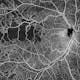 HD Angio 12x12mm Swept-Source OCT Angiography of Branch Retinal Vein Occlusion scanned at 200kHz scan speed