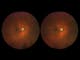 Stereo image pairs can be captured for stereoscopic evaluation of the fundus