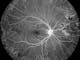 Fluorescein Angiography of a proliferative diabetic retinopathy