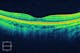 OCT retina scan