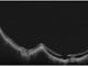 ZEISS PLEX Elite Ultra HD Spotlight of a Myopic Staphyloma