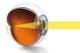 O LIO torică implantată în ochi.