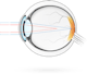 L'astigmatisme – condition dans laquelle la surface de la cornée présente une courbure asymétrique, de sorte que les rayons lumineux sont focalisés en deux points au lieu d'un seul, ce qui cause une vision floue