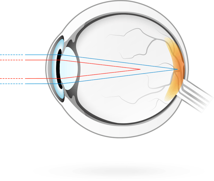 vedere încețoșată cu astigmatism