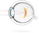 Miopía – afección en la que las imágenes visuales se enfocan delante de la retina, haciendo que la visión de lejos resulte borrosa