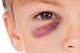 What is a black eye, and what causes it?