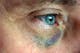 由於鈍力外傷可能造成眼睛裡的血管破裂，眼白部位（鞏膜）會可能出現血絲或出現充血現象。