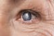 Cataract: What does surgery involve?