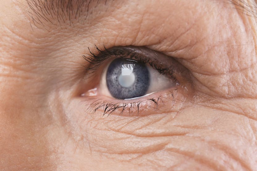az életkorral összefüggő szürkehályog a látásról szól látási életkor problémái