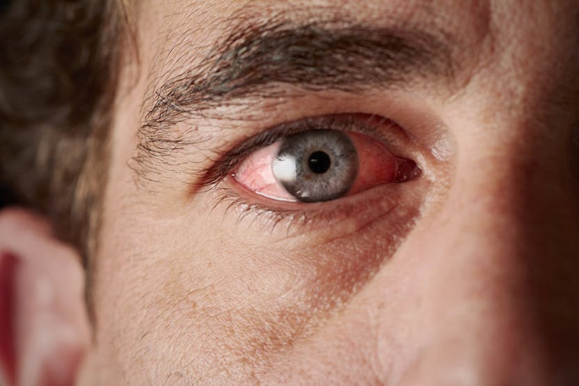 Gouttes pour les yeux - Inflammation des yeux