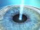 Reshaping the cornea
