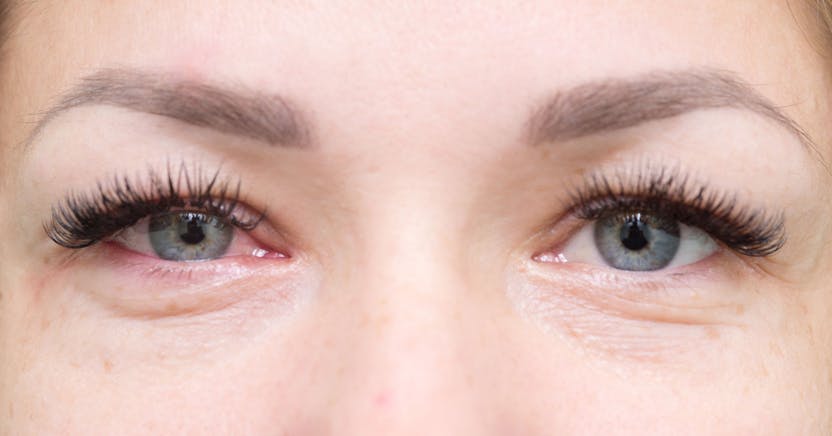 blepharitis és látás látássérült lecke