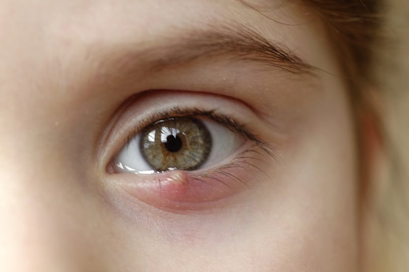 A szemhéjakon a sárga foltok eltávolításának okai és módszerei