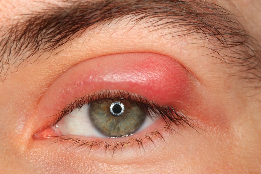 Jak poznat infekcí v oku?