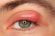 Eyelid infection (blepharitis) 