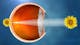 Waht is Cataract - Healthy vision
