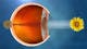 Waht is Cataract - Vision impaired by cataract