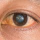 Grauer Star; die Augenlinse ist eingetrübt